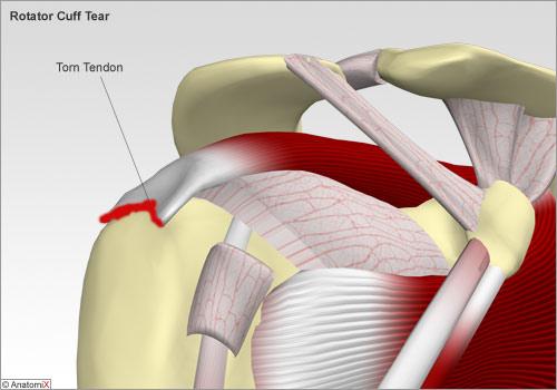 https://www.shoulder-info.com/patients/shoulder/rotator_cuff_tear.htm